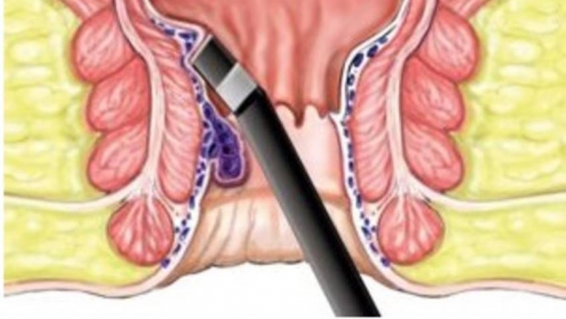 5 Reasons to Choose Laser Treatment for Piles Over Traditional Surgery
